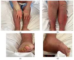 Image result for scabies norvegica