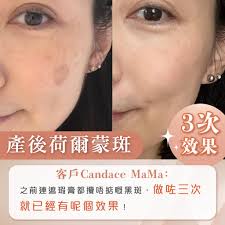 真．香港祛斑專家｜#2次KO色斑之真實見證，明碼實價限定：首次體驗$380 + $3980/3次3月預約時間較滿，Whatsapp即時預約熱線:  https://wa.link/rrg7k5 #Candacemama3次趕產後荷爾蒙斑實效: