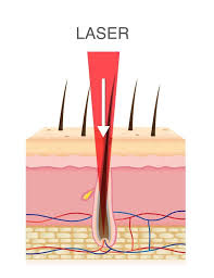 Laser hair removal also has one significant limitation. Home Laser Ipl Hair Removal Everything You Need To Know