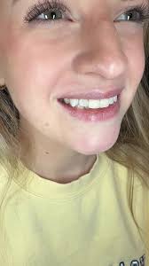 Understanding Dry Socket After Tooth Extraction