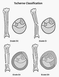 Tscherne classification (principles of fracture 1, dr. Oestern And Tscherne Classification For Closed Fractures Epomedicine