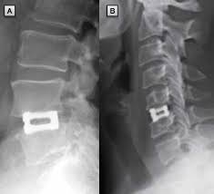 Preoperative radiotherapy was a morbid cofactor. The Varilift Interbody Fusion System Expandable Standalone Inte Mder