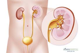 Kidney Stone Removal Treatment In Ahmedabad Kidney Hospital Ahmedabad