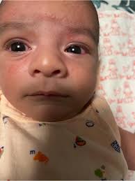 Hi moms, Looking for some quick advice and reassurance here. Our 6-week-old  baby boy has had sticky eyes since yesterday and both eyes are watery, red,  and now there's some yellowish pus