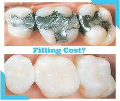 How Much Does A Filling Cost Worldwide Dental Fillings Dental Cosmetics Restorative Dentistry