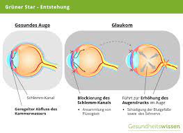 Gruner Star Ursachen Symptome Diagnose Behandlung