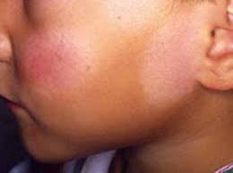 Pityriasis alba pityriasis alba is a common skin condition affecting mainly children and young adults and is thought to be related to eczema. Best Homeopathic Doctor Treatment For Pityriasis Alba In India