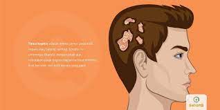 Tinea Kapitis Adalah Infeksi Jamur Pada Kulit Kepala Dan Batang Rambut Yang Dapat Ditandai Dengan Ciri Pitak Dan Botak Pada Beberapa Bagia Tanda Kulit Penyakit