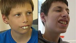 However, i feel like they make me 'me'. Bullied Buck Toothed Kid Finally Gets His Perfect Smile Newshub