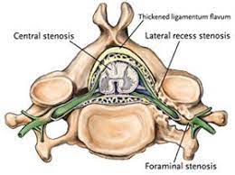 The central canal lies below and is connected to the ventricular system of the brain, from which it receives cerebrospinal fluid, and shares the same ependymal lining. Types Of Spinal Stenosis Central Canal Compresses Spinal Cord Lateral And Foraminal Compress Nerve Root Spinal Stenosis Stenosis Spinal Canal