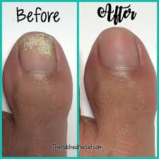 How To Remove White Marks On Toe Nails The Polished Pursuit Toe Nail Discoloration Toe Nails White Gel Toe Nails