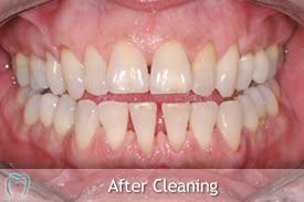 Check spelling or type a new query. Scale Polish Professional Dental Cleaning