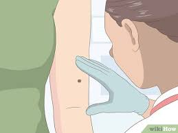 La dermato m'a fait un petit point. 3 Manieres De Faire Disparaitre Rapidement Des Grains De Beaute
