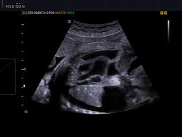 • when an ultrasound assessment has defined a better position for access to a pleural effusion. Ultrasound Images Fetus Bilateral Pleural Effusion B Mode 516 Accuvix Xg