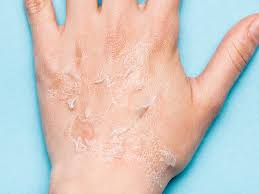 Image result for Hand Dermatitis