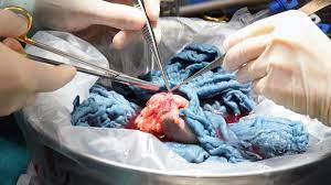 Organspende Ein Organtransplantierter Erzahlt Eine Tafel Schokolade Hatte Mich Umbringen Konnen Stern De