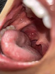 Un puntino bianco sul lato destro posteriore della gola — nessun dolore o  sintomi, ma sono preoccupato. [Foto allegata] : raskdentists