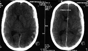 A thrombotic obstruction of the cerebral veins and/or related anatomical structures (dural sinuses) which drain blood from the brain. Acute Subdural Hematoma Secondary To Cerebral Venous Sinus Thrombosis Case Report And Review Of Literature Abstract Europe Pmc