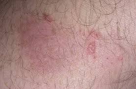 Hsv 2 virus is a type of hsv simple known as herpes simplex 2. Herpes Initial Stage Pictures 8 Photos Images Illnessee Com