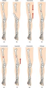 Also called a torsion fracture, a spiral my son suffered a spiral femur fracture and the er doctor didn't report it. Types Of Bone Fractures Imaging And Management Lecturio