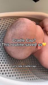 Image result for Cradle Cap