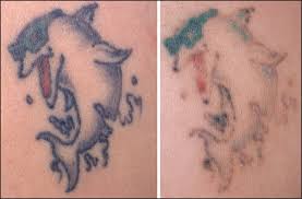 Lasers remove tattoos by breaking up the laser tattoo removal is uncomfortable, but most patients don't need anesthesia. Laser Tattoo Removal A Clinical Update Ho Sg Goh Cl J Cutan Aesthet Surg