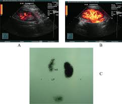 Renal clearance is greater in healthy. New Strategy Of Color And Power Doppler Sonography Combined With Dmsa In The Assessment Of Acute Pyelonephritis In Infants Bmc Nephrology Full Text