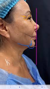 𝐄𝐥 𝐦𝐞𝐧𝐭𝐨𝐧 𝐥𝐨 𝐞𝐬 𝐭𝐨𝐝𝐨 🔥, Y esto lo da un buen análisis  facial. , Mentoplastia de avance SIN implante, con su propio hueso y  blefaroplastia (rejuvenecimiento de la mirada)., 2 meses de cirugía.,  𝐺𝑟𝑎𝑐𝑖𝑎𝑠 ...