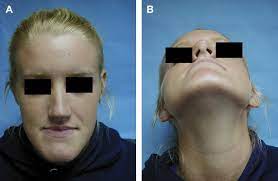 Basic liposuction training (lipo 201). Esthetic Options With Two Jaw Surgery Oral And Maxillofacial Surgery Clinics