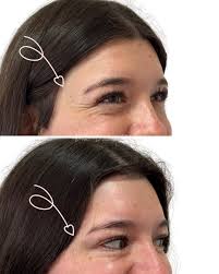 Mirada fresca y natural con Toxina Botulínica ✨ Resultados sutiles,  disminuyendo las arruguitas dinámicas y dejando una piel más radiante. La  clave es resaltar tu juventud sin perder tu expresión. 💖 ¡Gracias