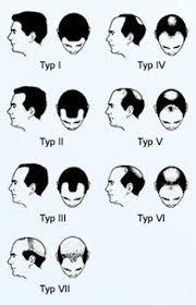 Und wie kann man haarausfall stoppen? Wann Ist Eine Haartransplantation Sinnvoll Die Phasen Des Haarausfalls Nach Hamilton Norwood