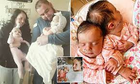 Contemporary approaches to visual prostheses @article{mirochnik2019contemporaryat, title={contemporary approaches to visual prostheses}, author={rebecca m. Parents Of Twin Girls Born Conjoined At The Head Share Their Joy And Relief Over Successful Surgery Daily Mail Online