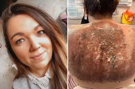 Mum, 31, left with third-degree burns the size of a TV