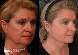 Maybe you would like to learn more about one of these? Embracerf Nyc Facetite Treatment Bodysculpt
