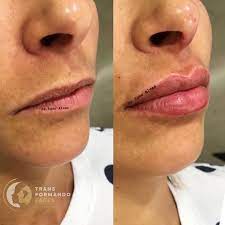 Dr Igor Alves On Instagram Que O Medo Das Pessoas De Fazer Preenchimento Labial Acabe Preenchimentolabial Preenchimentofacial Make Up