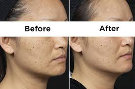 If your skin is already on the dry side, she recommends using the sandwich technique: use a light moisturizer first and wait a few minutes for it to absorb into your skin before you apply. Here Are Some Life Changing Products For Acne Scars And Dark Spots