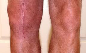 Possible Knee Replacement Surgery Complications Knee Replacement Knee Replacement Surgery Knee Replacement Exercises