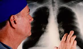 lung cancer is the uncontrolled growth of abnormal cells (a malignant tumor) that begins in the cells of the lungs. Mesothelioma Lung Cancer Caused By Inhaling Asbestos Askyourlawyer Com