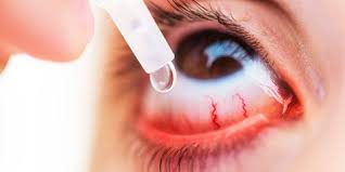 Mata merah bisa disertai mata yang kering, sehingga beberapa pilihan perawatan akan mengatasi keduanya. Beberapa Cara Ini Efektif Mengatasi Mata Merah Akibat Kondisi Mata Kering