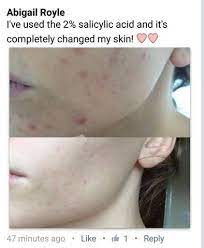 See full list on mayoclinic.org How Does Salicylic Acid Work