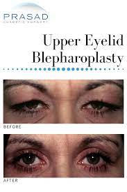 Upper Eyelid Surgery Eyelid Surgery Upper Eyelid Upper Eyelid Surgery