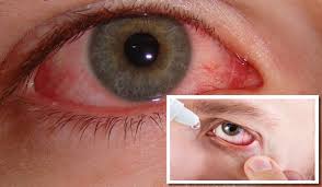 Image result for Eye Pain without Redness