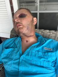 WE ARE HOME! Clayton is doing well. His bruising looks like Holly hit him  with a baseball bat for stepping out of line but he's not in too much pain.  Seems like