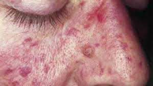 This occurs because the skin and the blood vessels become more fragile as we age, making it easier for our skin to bruise from minor trauma. Purpura Types Causes Diagnosis And Treatment