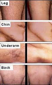 Your satisfaction is our top priority. Our Scottsdale Laser Hair Removal Services Are Gentle And Will Rid You Of All Of Your Unwanted Hair Laser Hair Removal Laser Hair Reduction Hair Removal