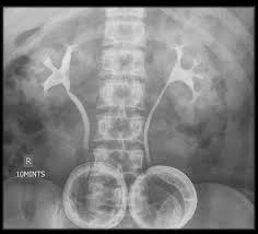 Image result for Intravenous Pyelogram