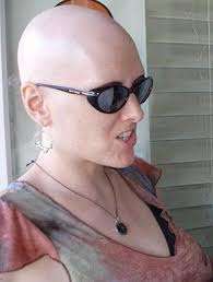 Having alopecia areata does not mean one will inevitably develop alopecia universalis — on the the primary symptom of alopecia universalis is extensive hair loss. Alopecia Totalis Wikipedia