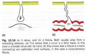 Fistula And Sinus Pilonidal Cyst Home Health Remedies Sinusitis