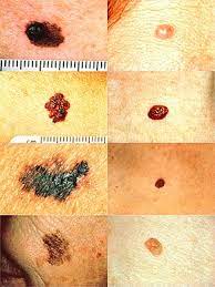 Learn more about targeted therapy, surgery, and chemotherapy. Melanoma Wikipedia