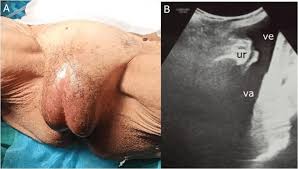 Image result for Labial Fusion